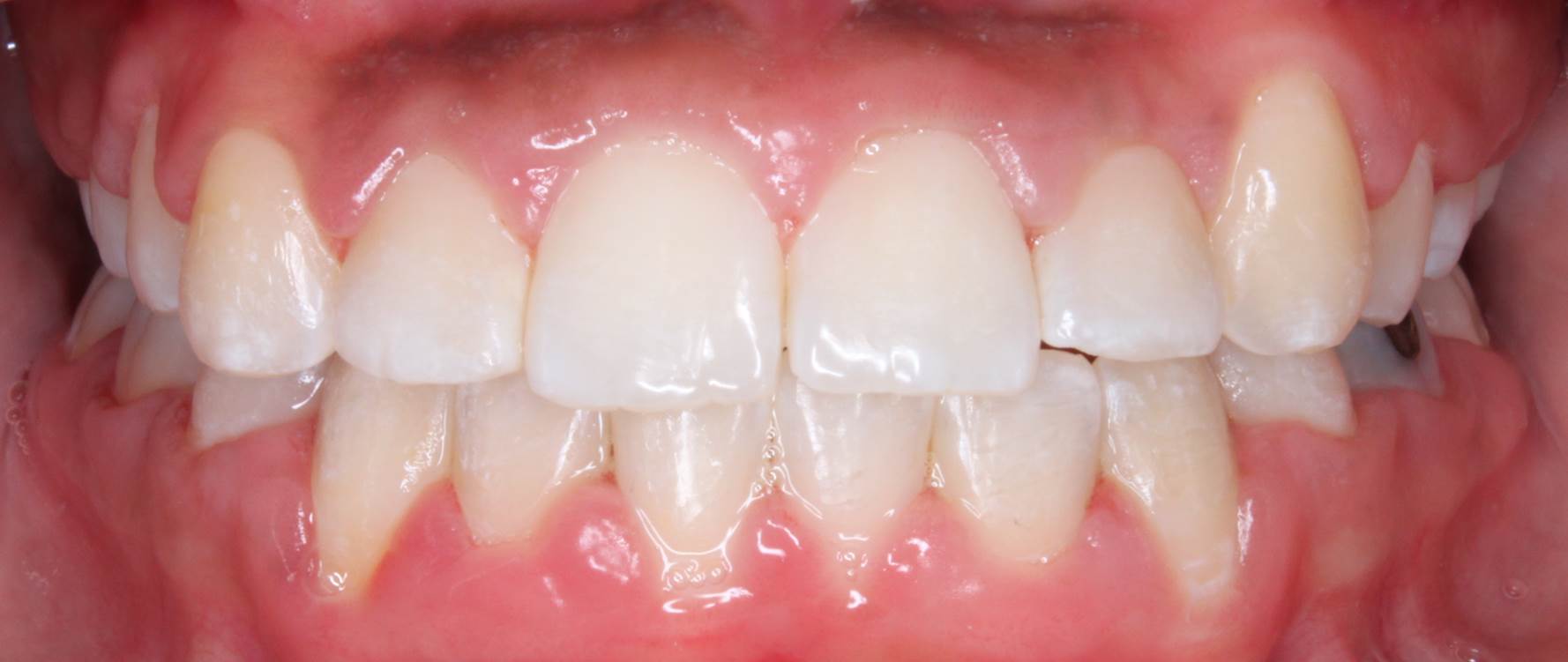 Crooked teeth after treatment