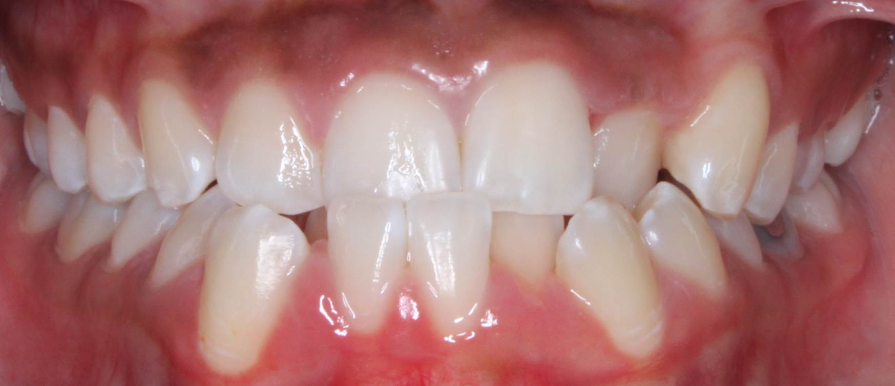 Crooked teeth before treatment