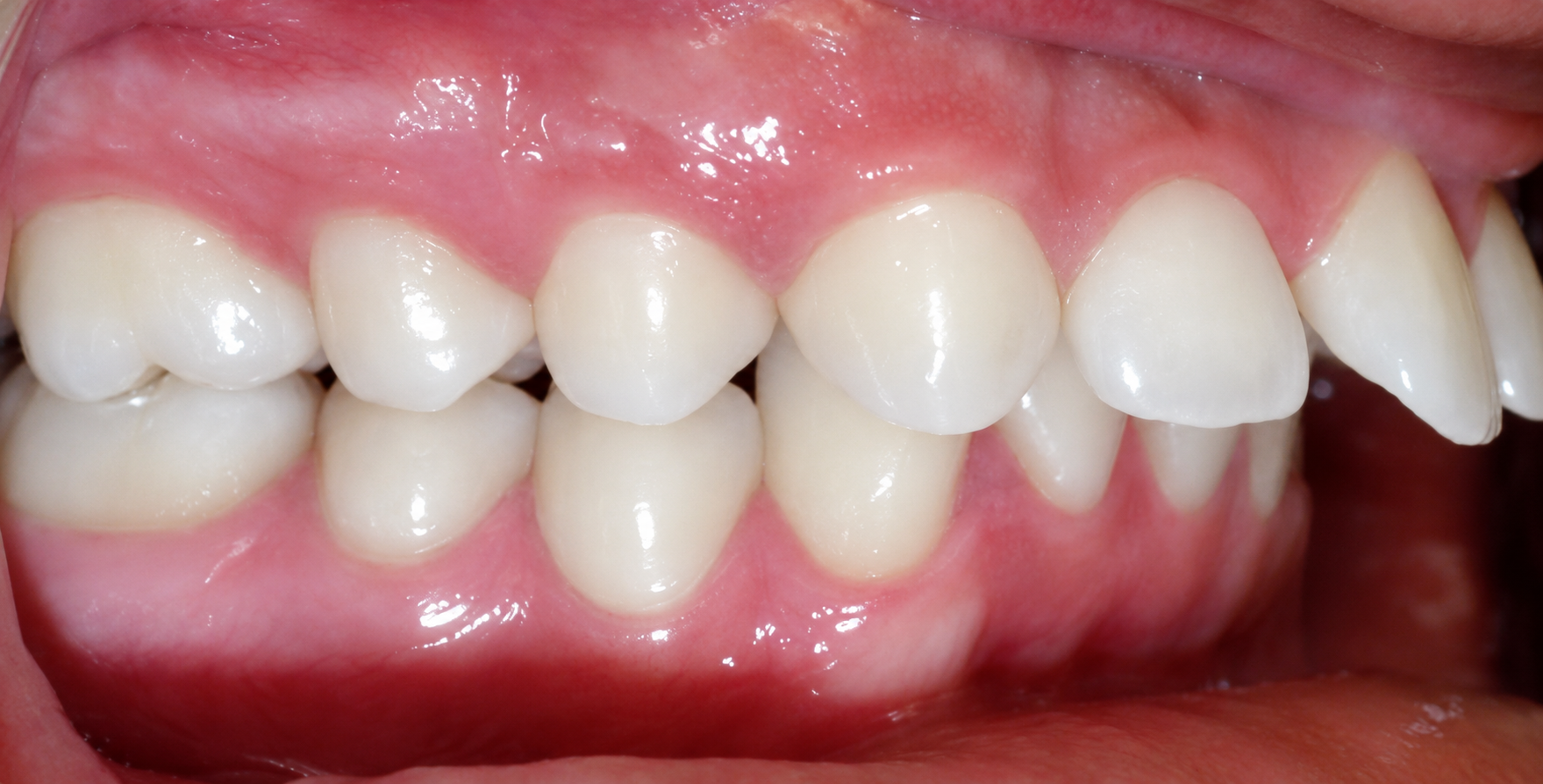 Side view of teeth with an overjet: upper front teeth sit well in front of the lower